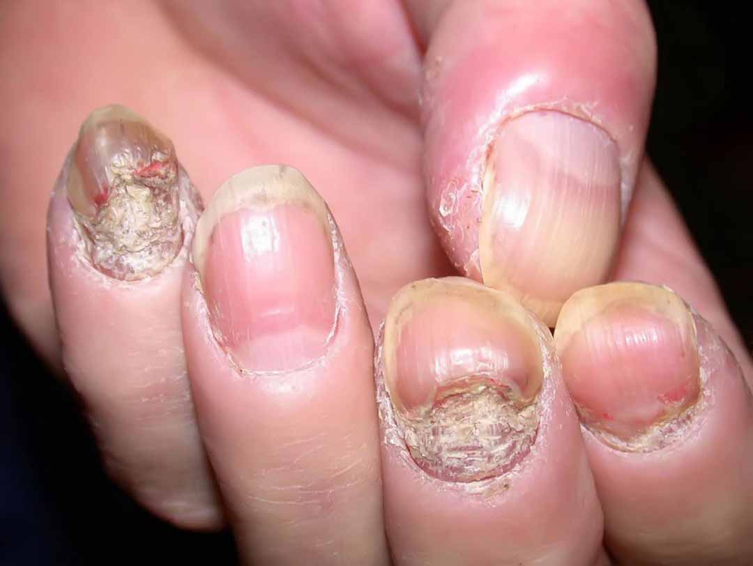 Nấm móng (Onychomycosis)