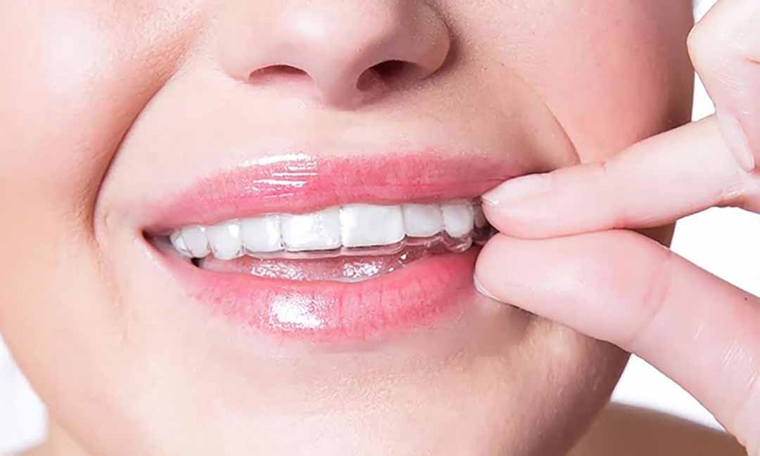 Niềng răng invisalign