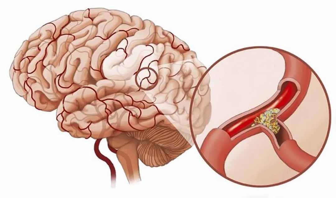 Phòng ngừa tai biến mạch máu não như thế nào?