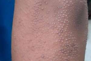 Dị sừng nang lông (Follicular dyskeratosis)