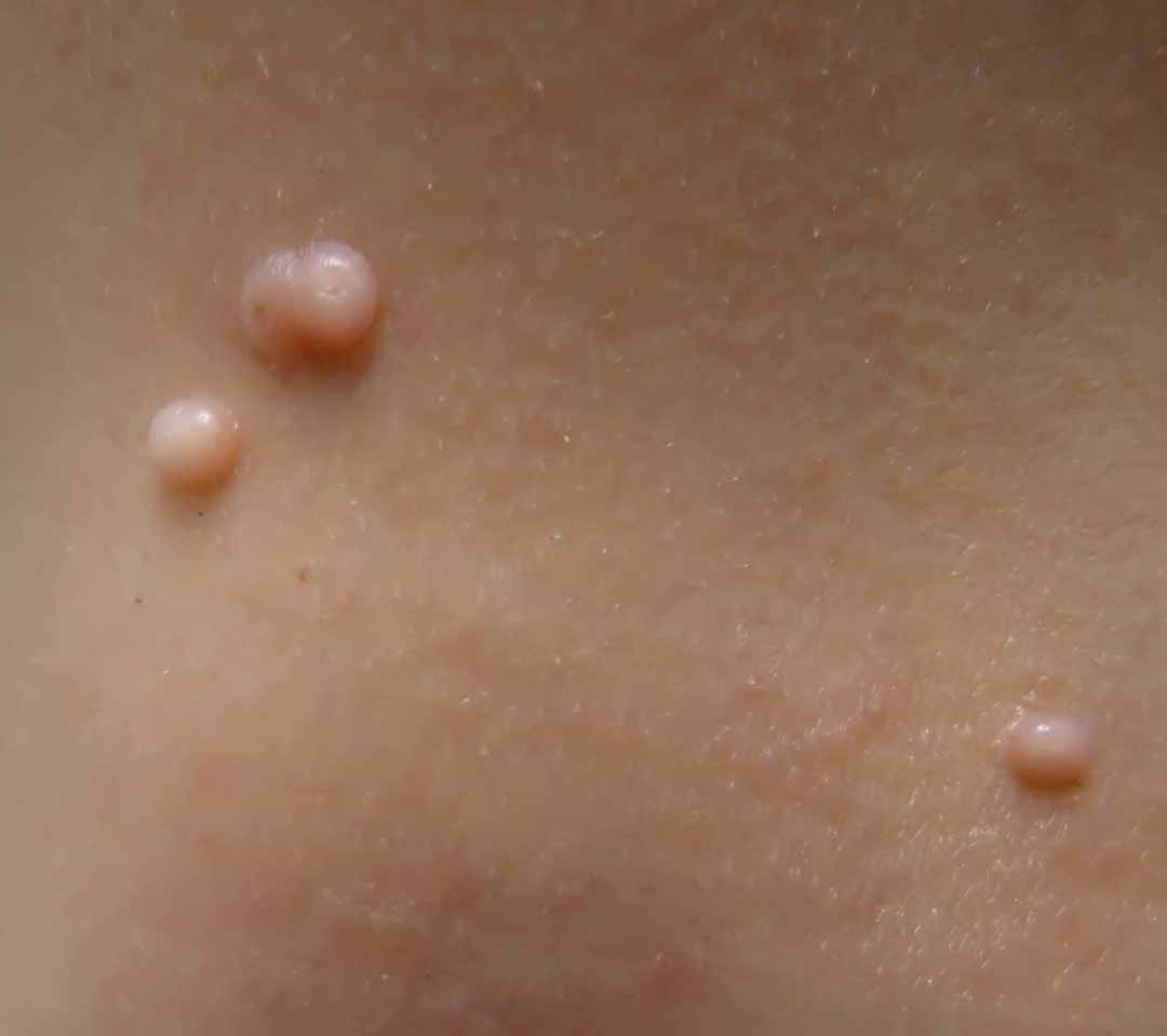 U mềm lây (Molluscum Contagiosum)