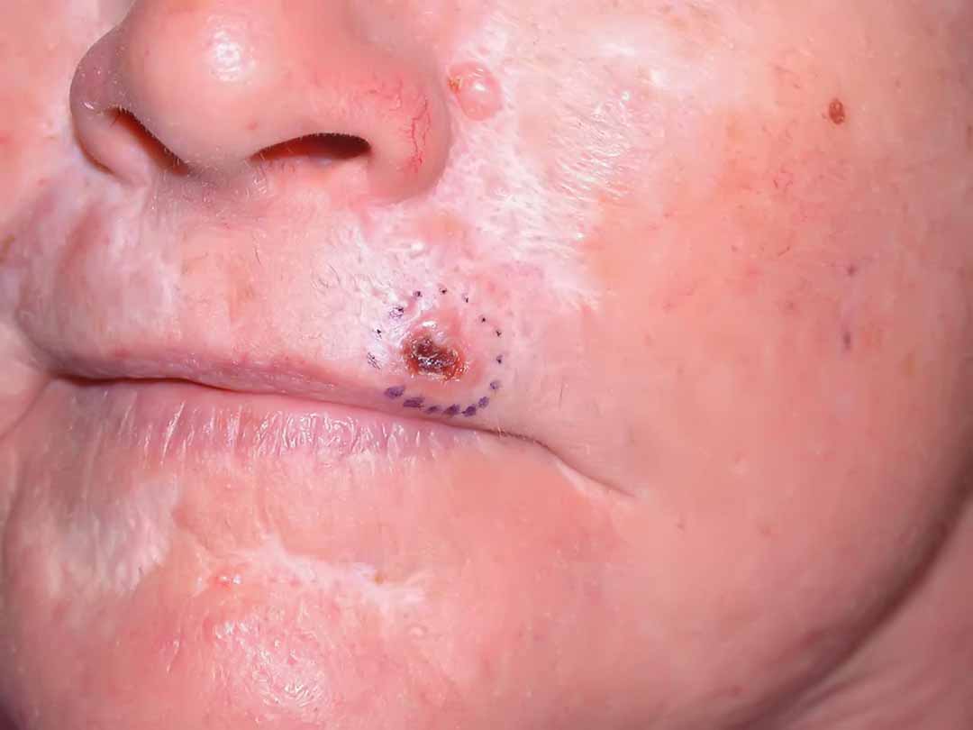 Ung thư tế bào đáy (Basal cell carcinoma - BCC)