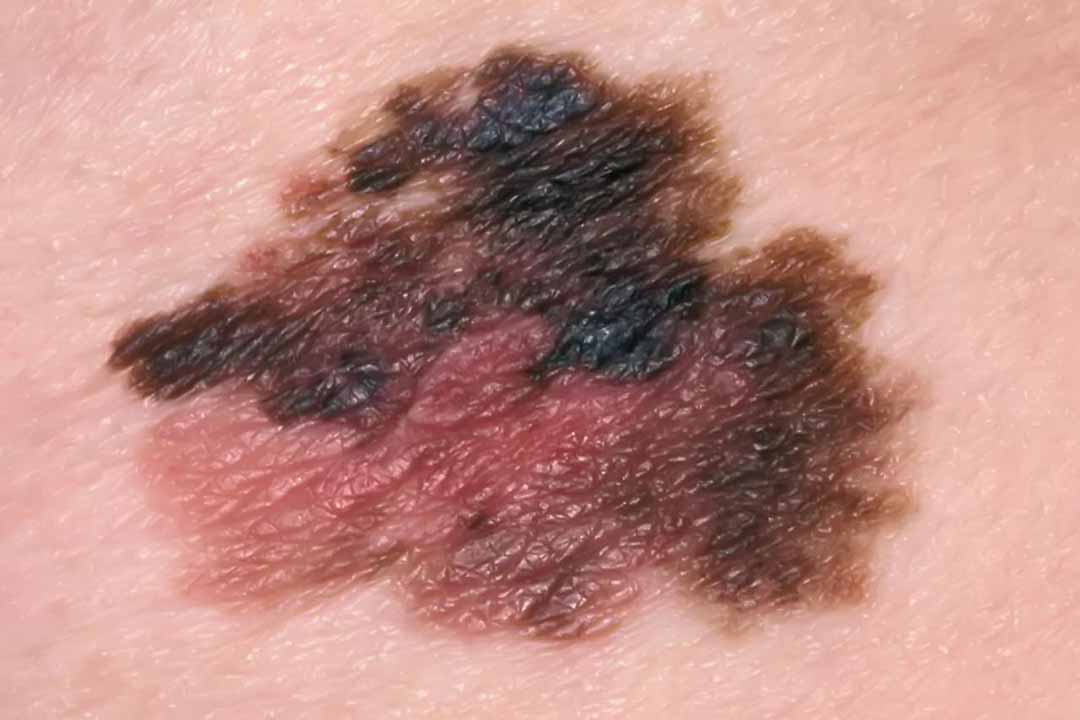 Ung thư tế bào hắc tố (Malignant melanoma)