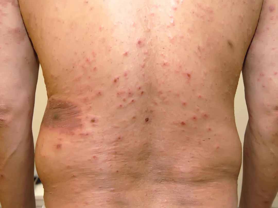 Vảy phấn hồng GIBERT (Pityriasis rosea of Gibert)