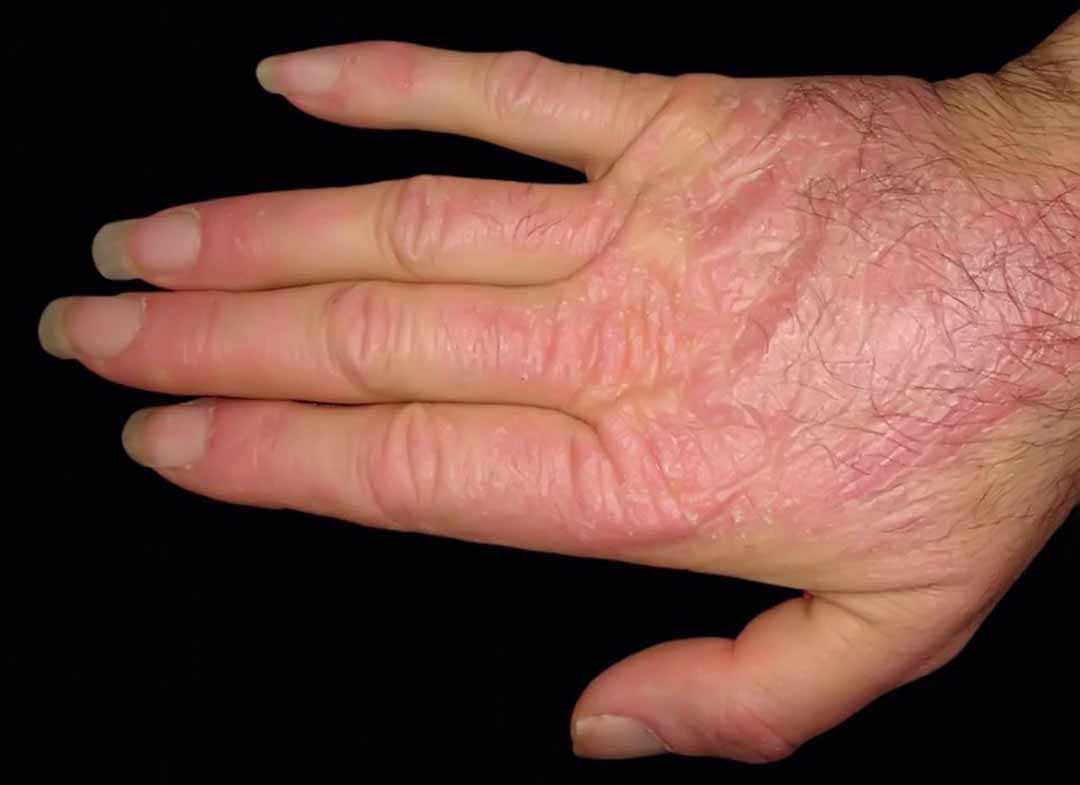 Viêm cơ bì (Dermatomyositis)