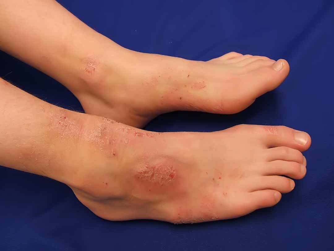 Viêm da cơ địa (Atopic dermatitis)