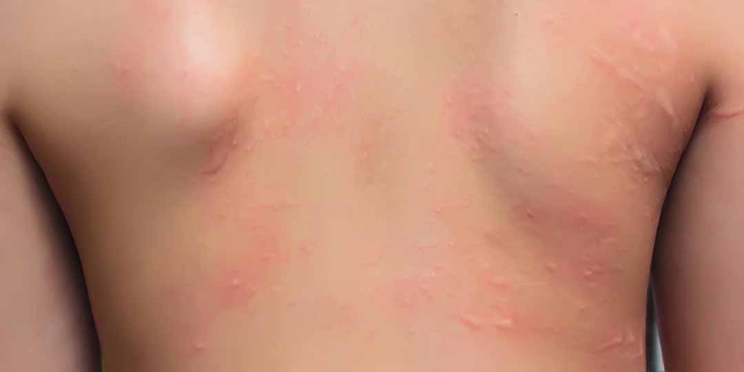 Viêm da tiếp xúc dị ứng (Allergic Contact Dermatitis)