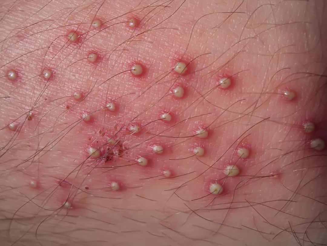 Viêm nang lông (FolliculitIs)