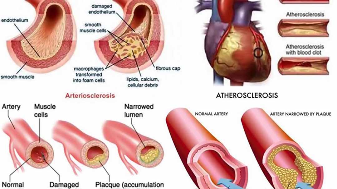 Phòng ngừa Huyết khối do xơ vữa động mạch, tránh nguy cơ tai biến mạch máu não và đột quỵ