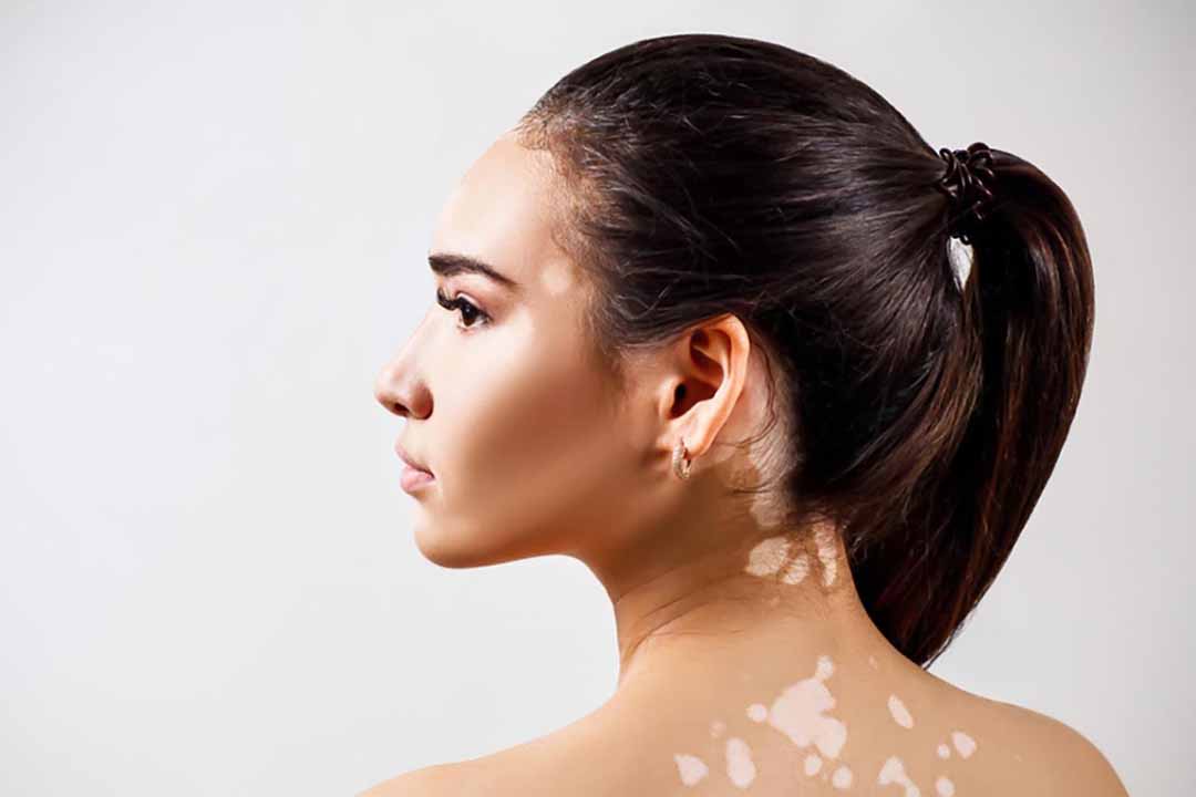 Triệu chứng và hướng điều trị bệnh bạch biến (Vitiligo)