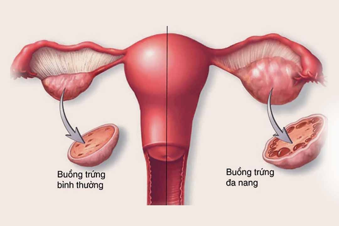 Nguyên nhân và hướng điều trị của hội chứng buồng trứng đa nang