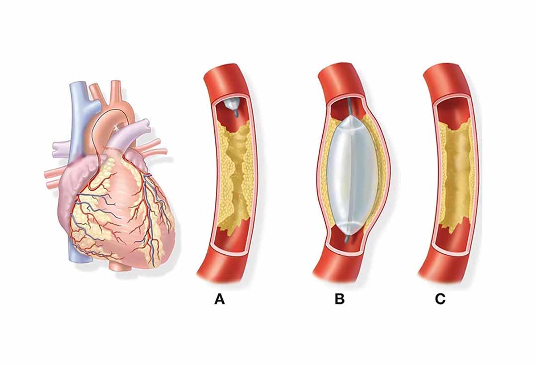 Баллонная коронарная ангиопластика. Баллонная ангиопластика аорты. Коронарная ангиопластика и стентирование. Баллонная ангиопластика и стентирование. Операция стентирование сосудов сердца.