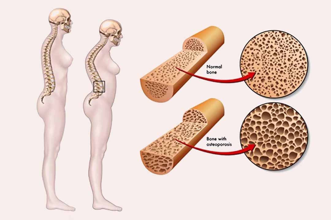 Bệnh loãng xương ở phụ nữ