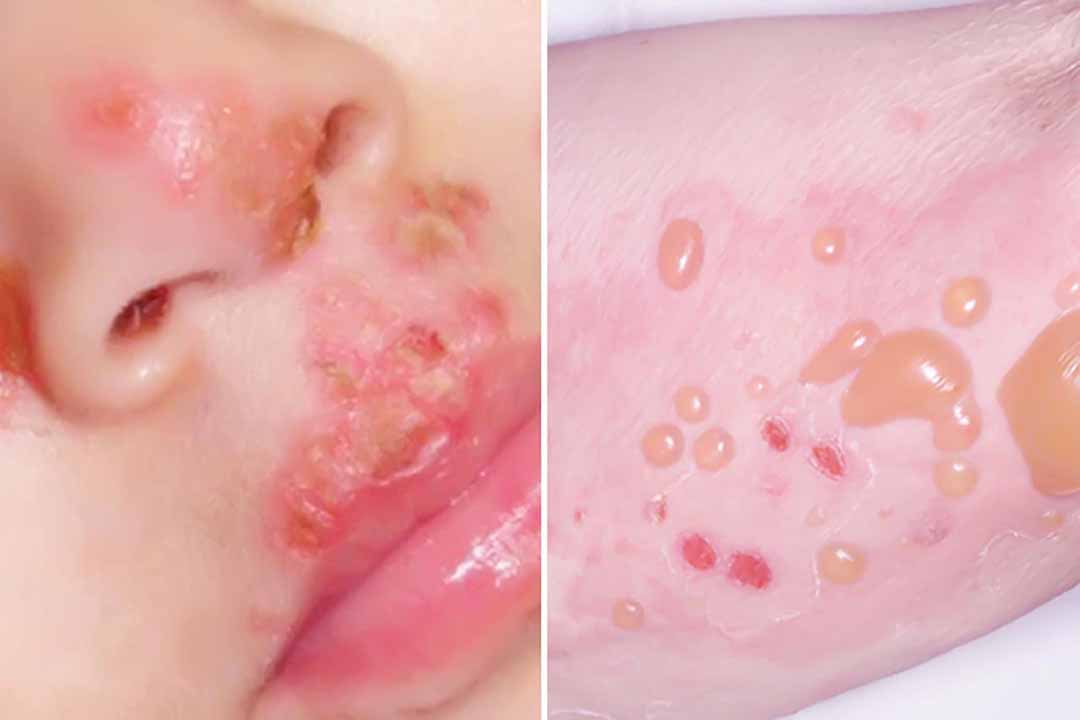 Bệnh Pemphigus