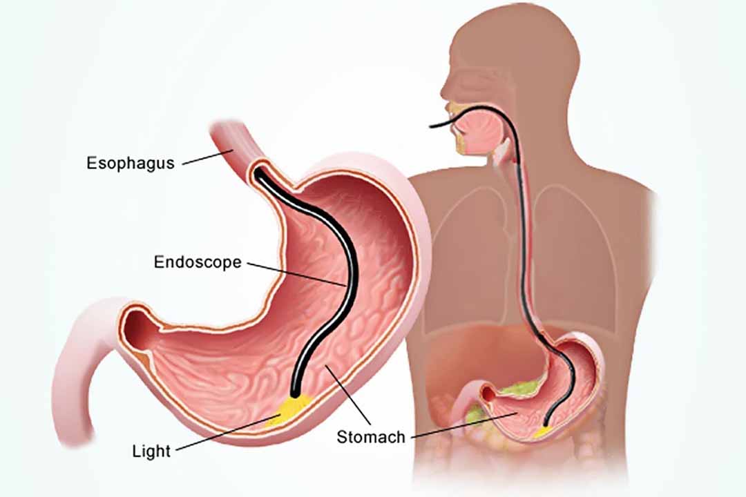 Nội soi điều trị