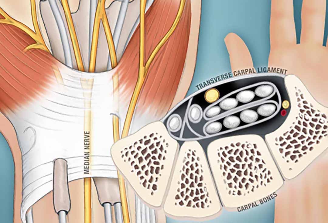 Hướng dẫn trực quan về hội chứng ống cổ tay