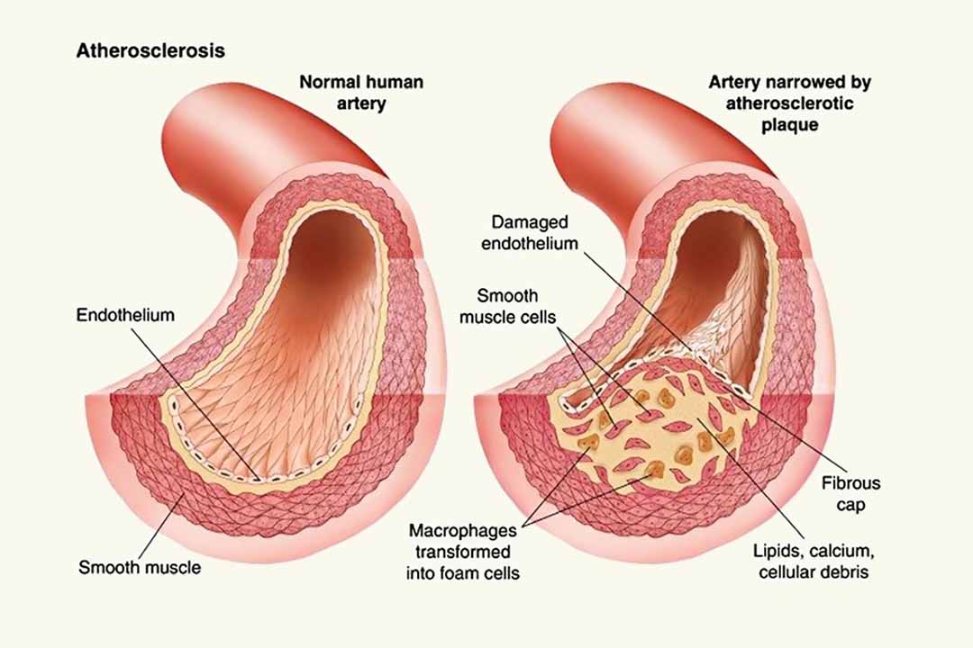 Xơ vữa động mạch và bệnh mạch vành