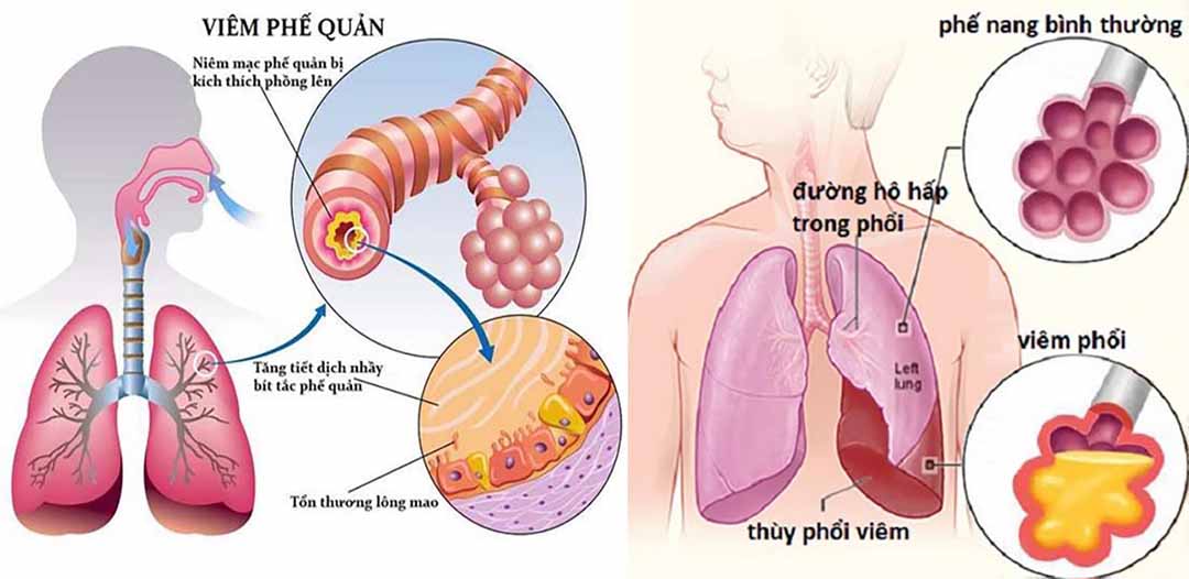 Một số kiến thức về bệnh Viêm phế quản và cách phòng trị