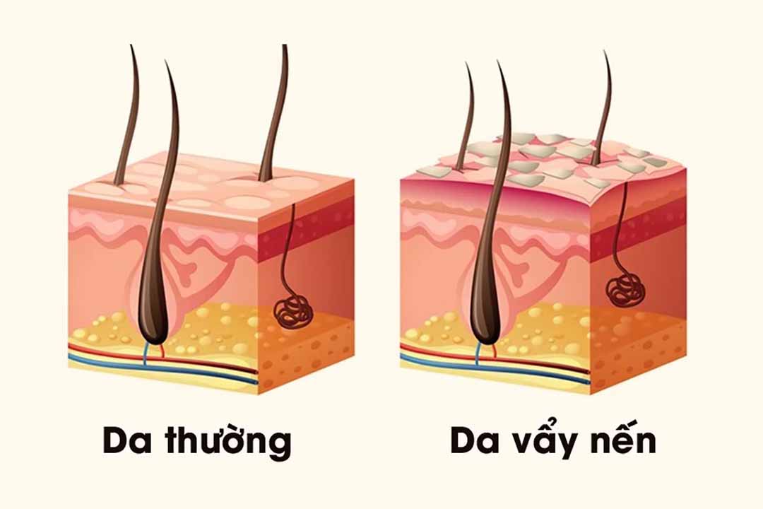 Bệnh vẩy nến của bạn nặng đến mức nào?