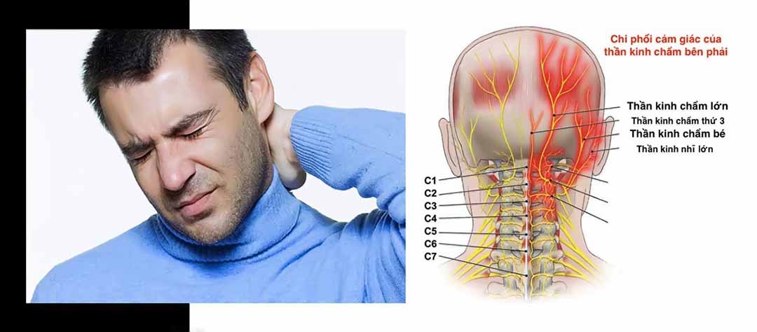 Đau vùng sau gáy là triệu chứng rõ rệt nhất.