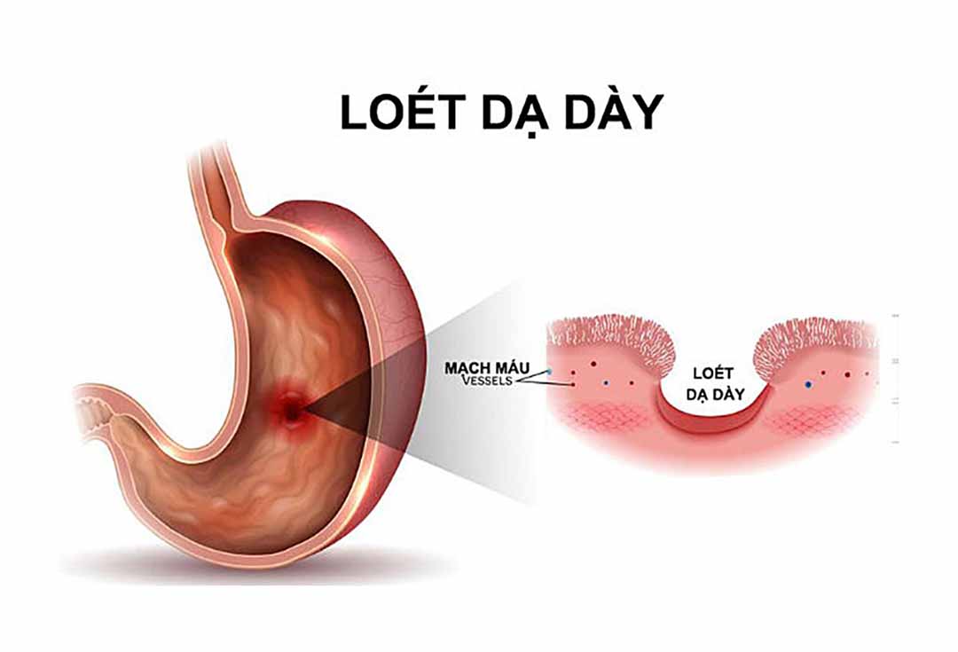 Viêm loét đường tiêu hóa