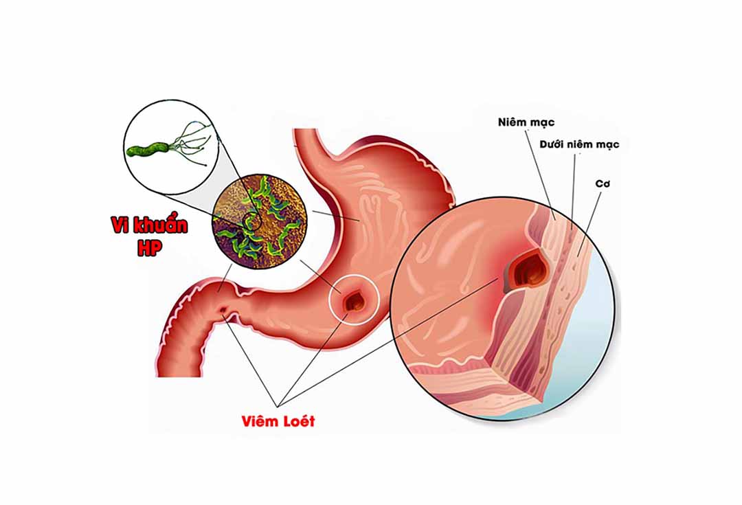 Tại sao trẻ đại tiện ra máu?