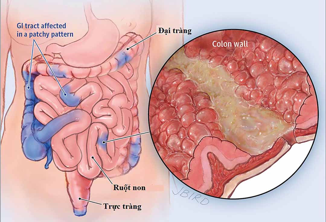 Tại sao tiêu chảy dễ dẫn đến mất nước, nhiễm độc axit?