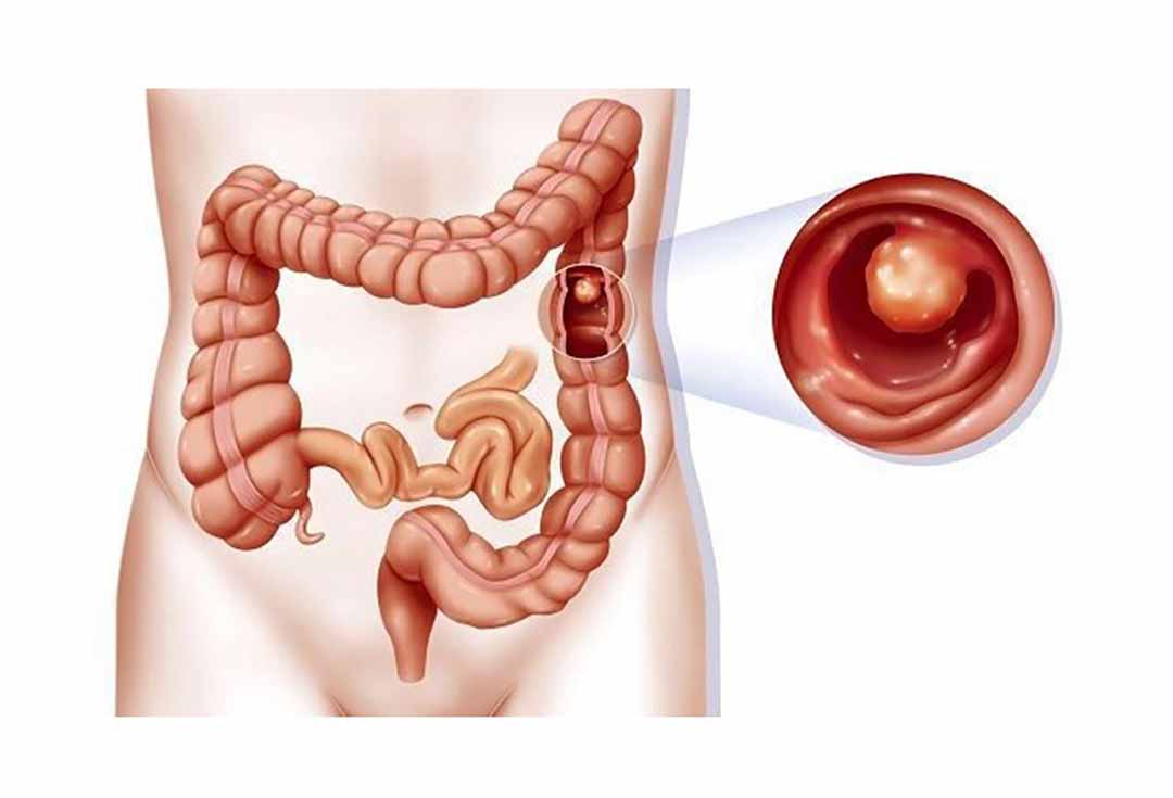 Tắc ruột bẩm sinh là gì?