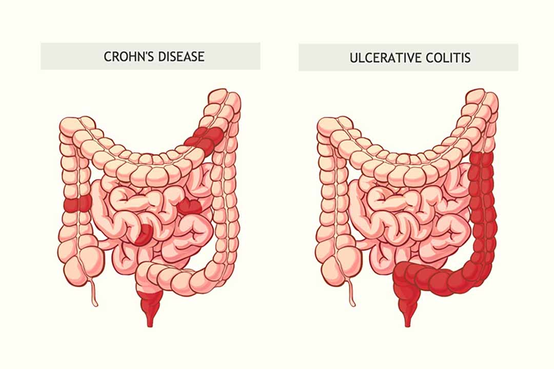 Bệnh crohn ở trẻ có biểu hiện gì?