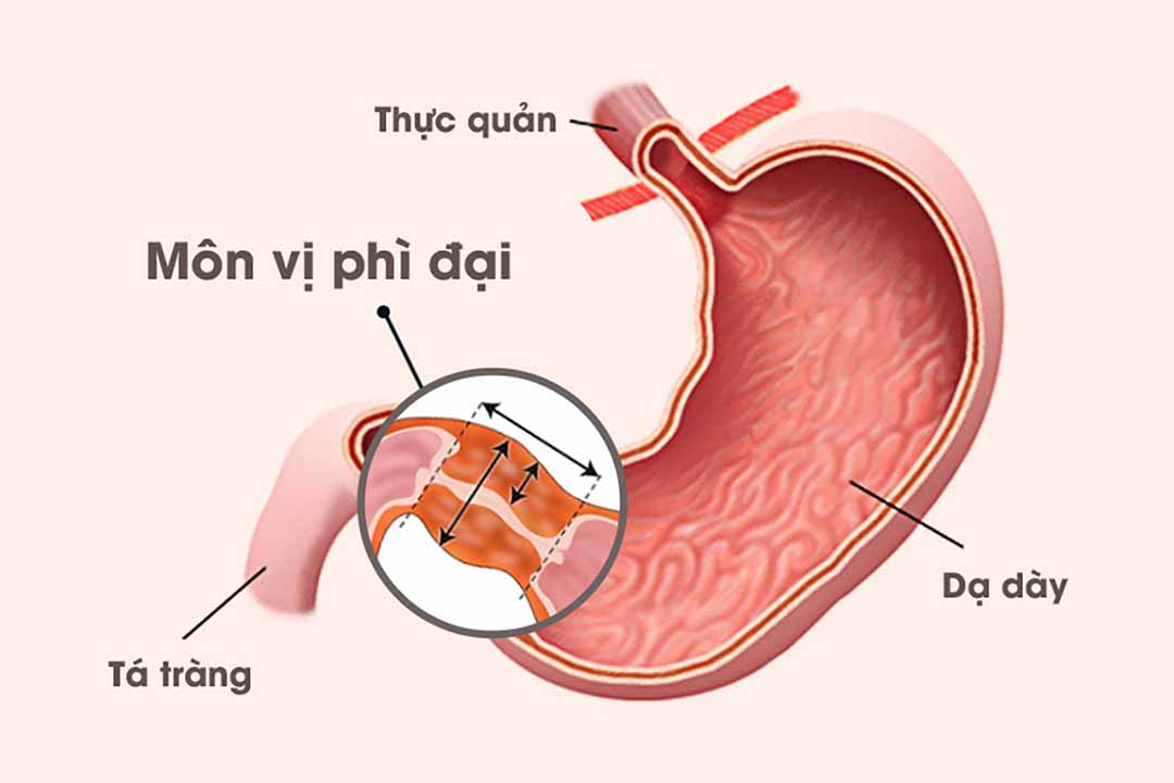 Hẹp môn vị phì đại bẩm sinh có đặc trưng gì?