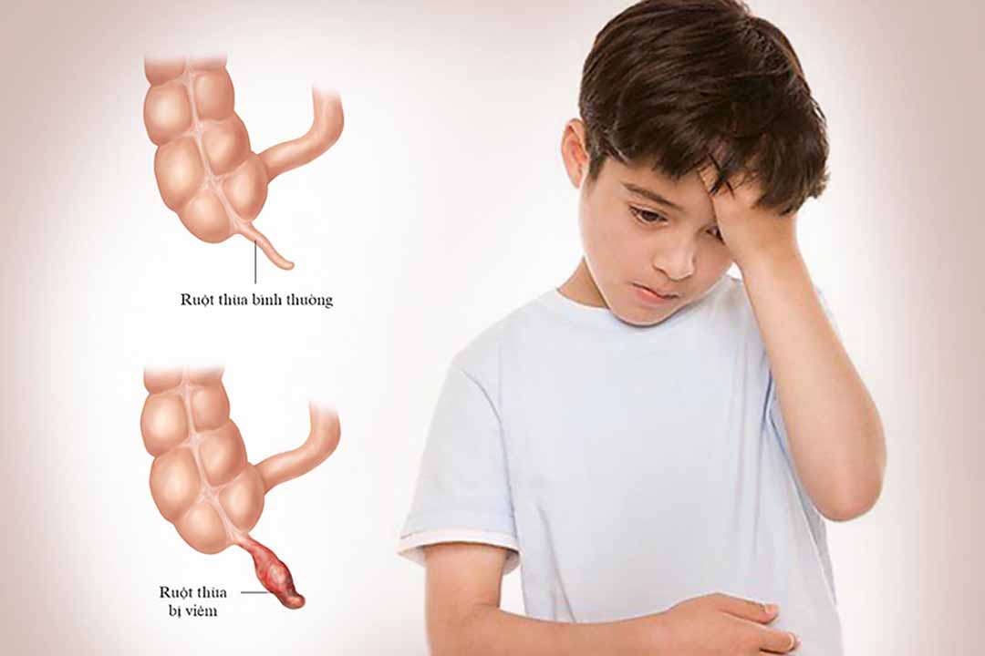 Làm sao chẩn đoán sớm viêm ruột thừa cấp tính ở trẻ em?