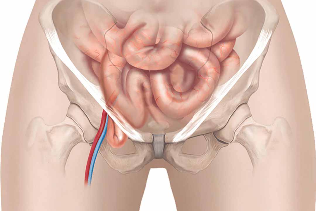 Làm sao điều trị chứng thoát vị ở trẻ em?