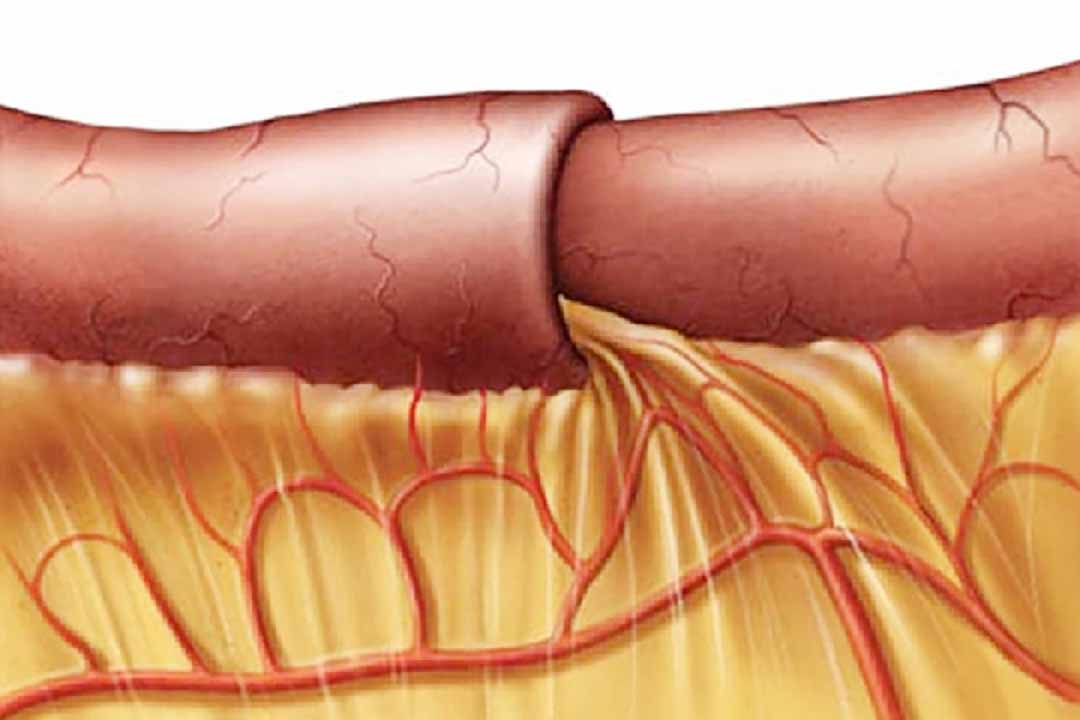 Lồng ruột ở trẻ em cẩn phân biệt với bệnh gì?