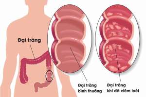 Làm sao điều trị viêm đại tràng thể loét mạn tính?