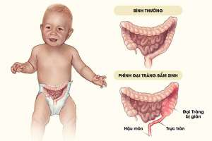 Phình đại tràng bẩm sinh có triệu chứng gì?