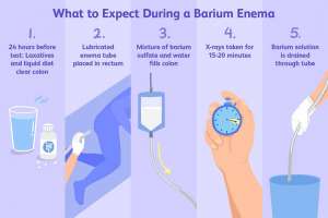 Thực hiện thụt ruột bằng bari như thế nào?
