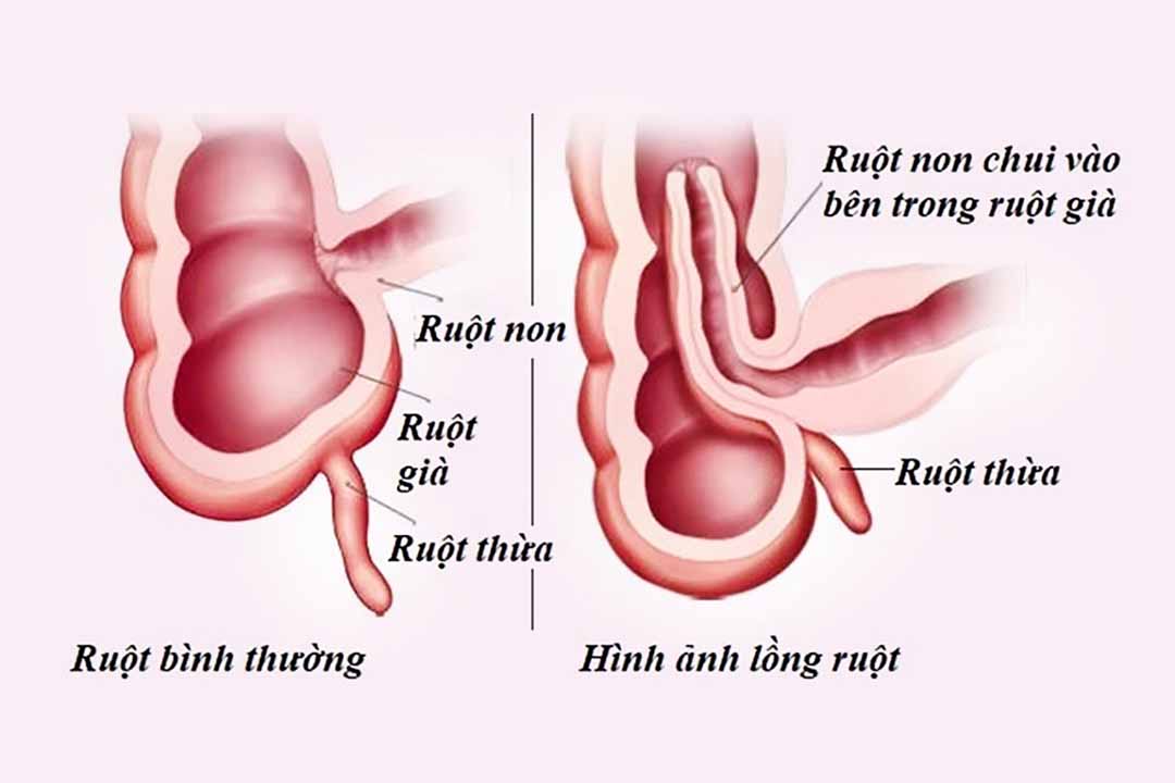 Trẻ lồng ruột có triệu chứng gì?