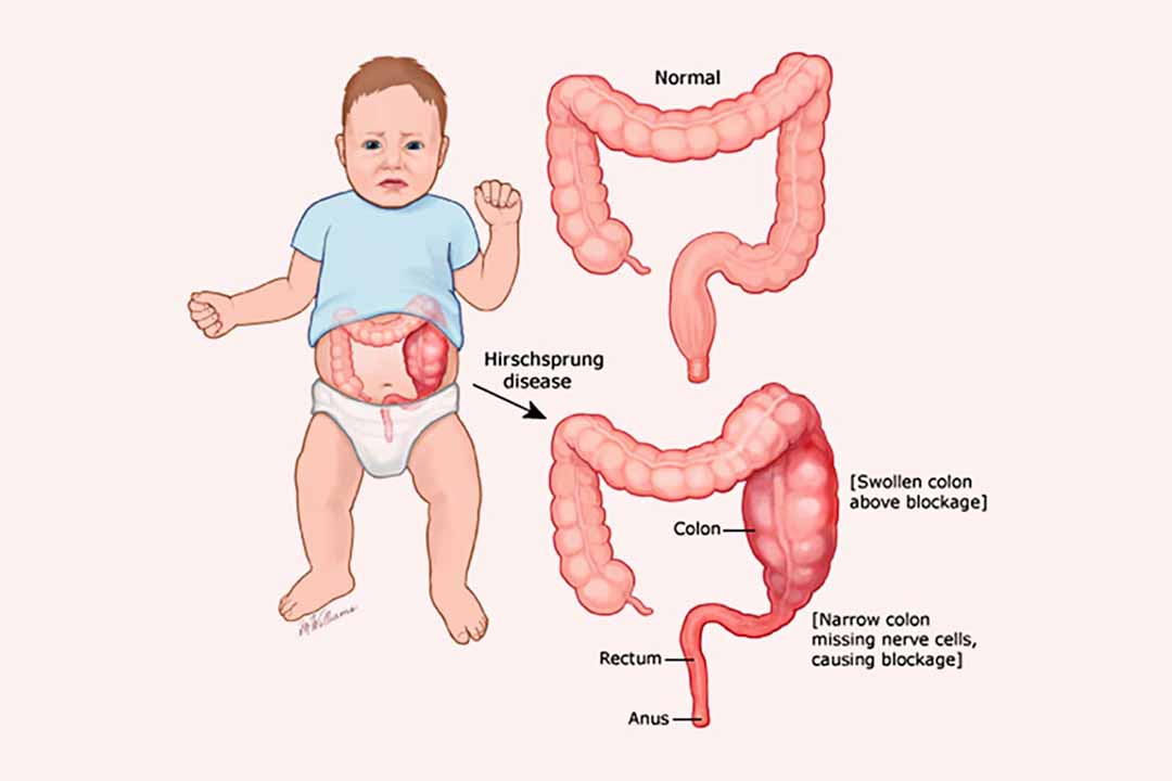 Viêm ruột hoại tử ở trẻ sơ sinh có biểu hiện gì?