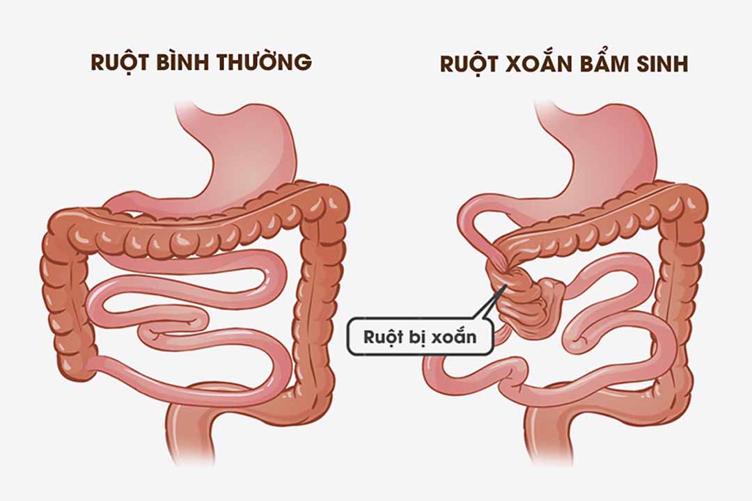 Xoắn ruột bẩm sinh có triệu chứng lâm sàng gì?