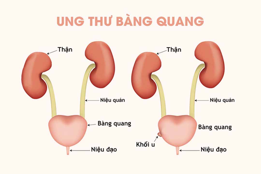 Ung thư bàng quang là gì và các yếu tố nguy cơ gây bệnh