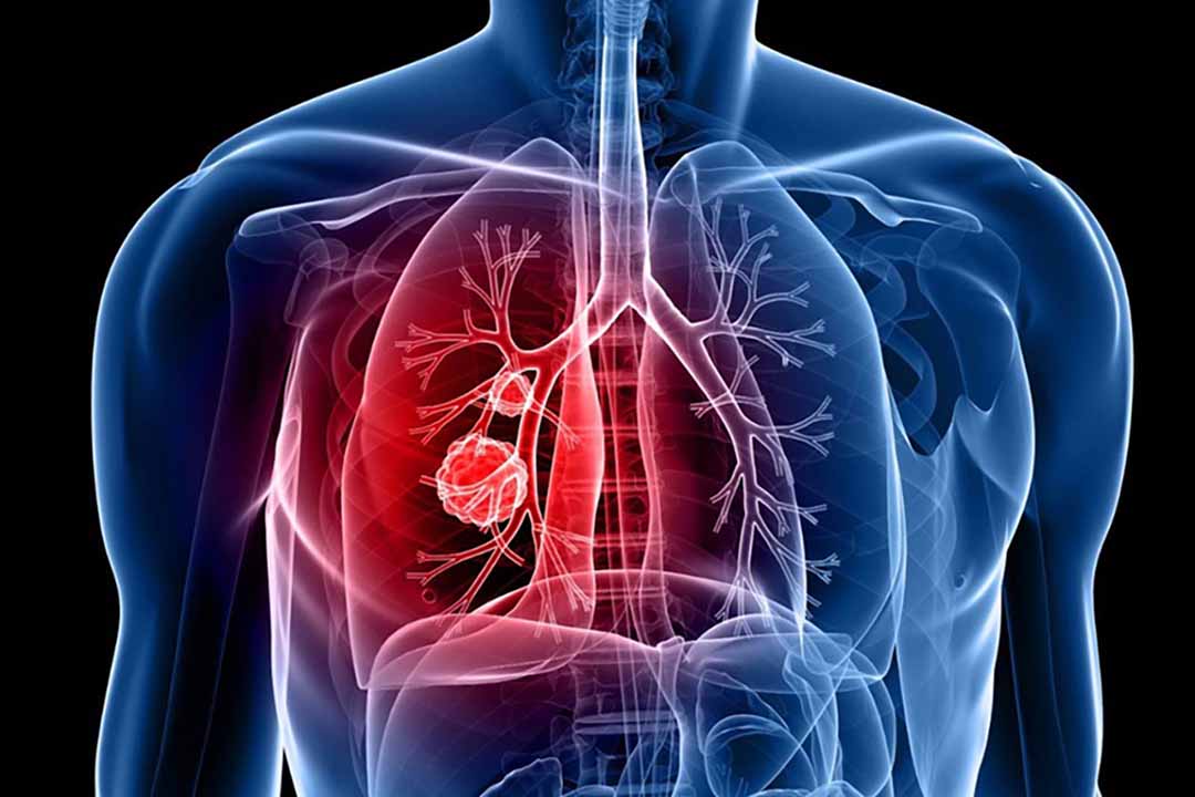 Bệnh ung thư phổi cần được điều trị sớm