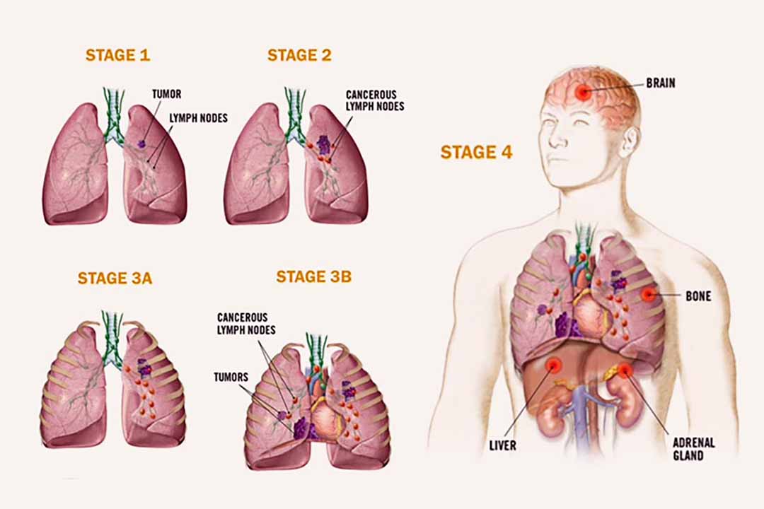 Các loại ung thư phổi