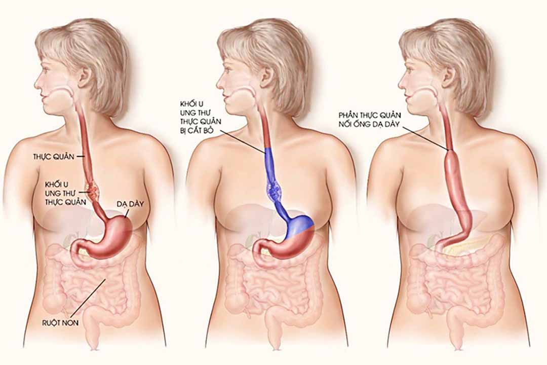 Điều trị ung thư thực quản