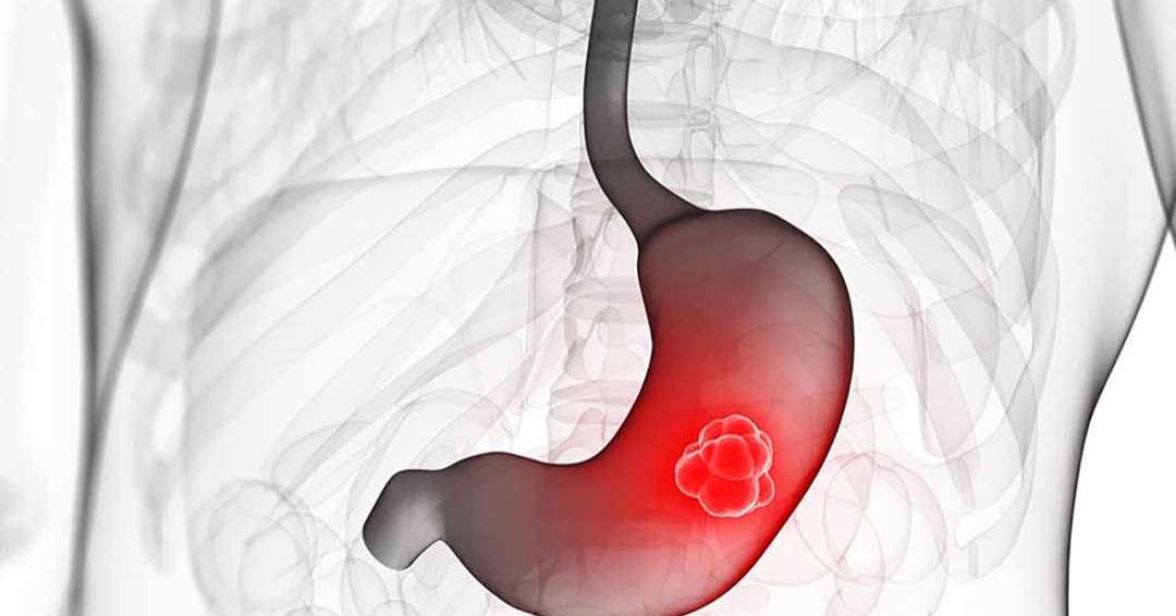 Рак желудка у мужчины. Злокачественное новообразование желудка. Злокачественная опухоль желудка.