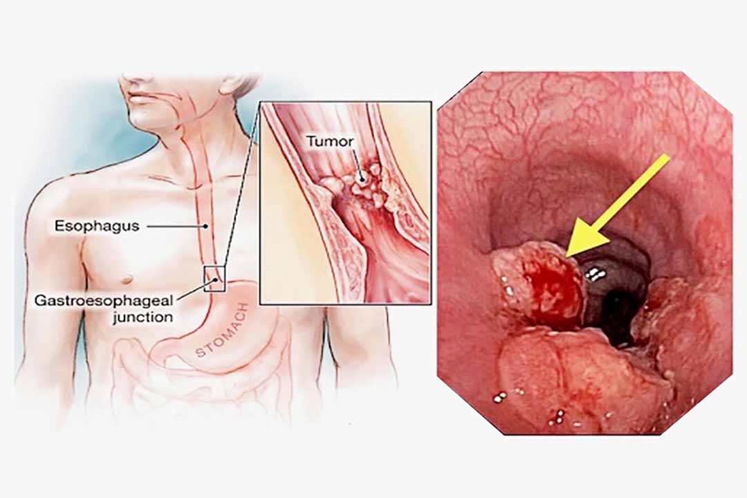 Những nguyên nhân nào gây ung thư thực quản?