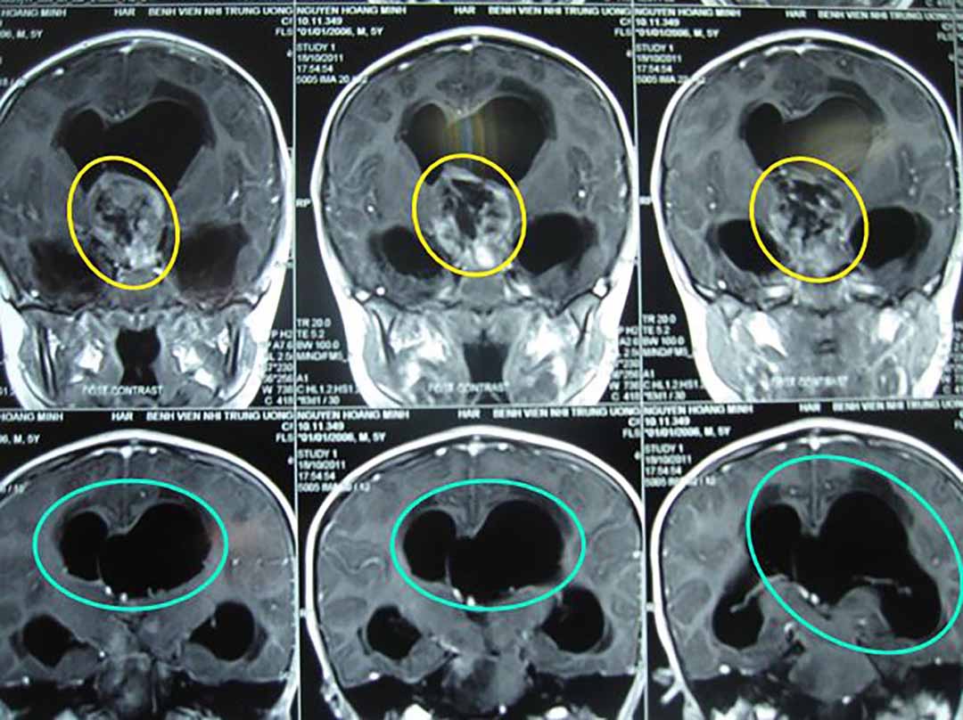 Trước điều trị: Hình ảnh chụp cộng hưởng từ (MRI) sọ não: là u sọ hầu (Vùng tổn thương trong vòng màu vàng; Vùng dãn não thất trong vòng màu xanh nhạt)