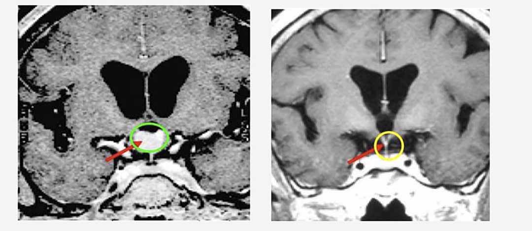  Hình ảnh MRI sọ não. Trước điều trị (hình bên trái): khối u sọ hầu (vòng tròn xanh). Sau điều trị 18 tháng (hình bên phải): khối u tan hết.