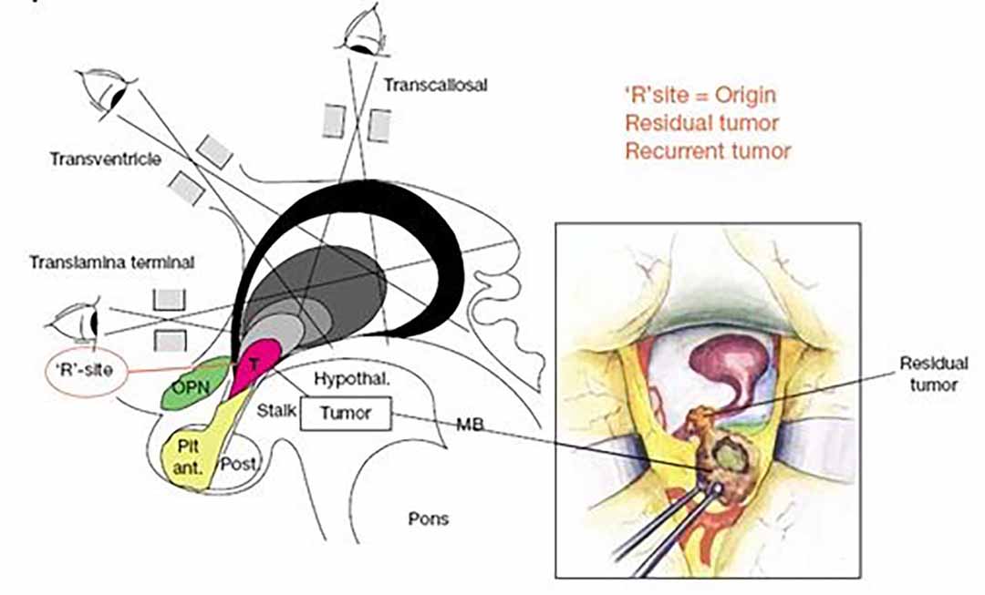 Sơ đồ khối u nhỏ vùng R nơi khối u xuất phát giữa dây thần kinh thị và ổ TB vảy, khối u có thể tồn tại và phát triển ở vị trí này, (R-site) là vị trí khó,