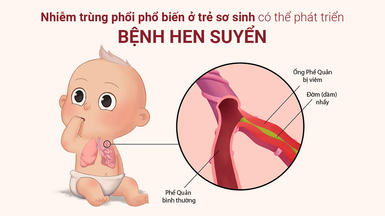 Nhiễm trùng phổi phổ biến ở trẻ sơ sinh có thể phát triển thành bệnh hen suyễn