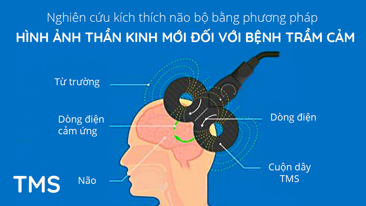 Nghiên cứu kích thích não bộ bằng phương pháp hình ảnh thần kinh mới đối với bệnh trầm cảm